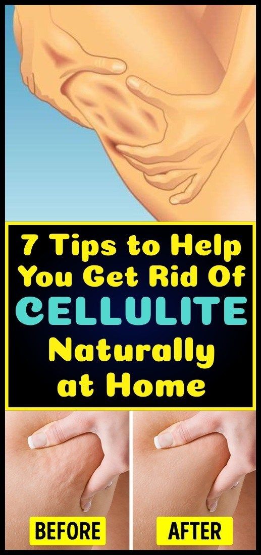 7 Tips to Help You Get Rid Of Cellulite Naturally at Home